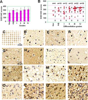 LCS-1 inhibition of superoxide dismutase 1 induces ROS-dependent death of glioma cells and degradates PARP and BRCA1